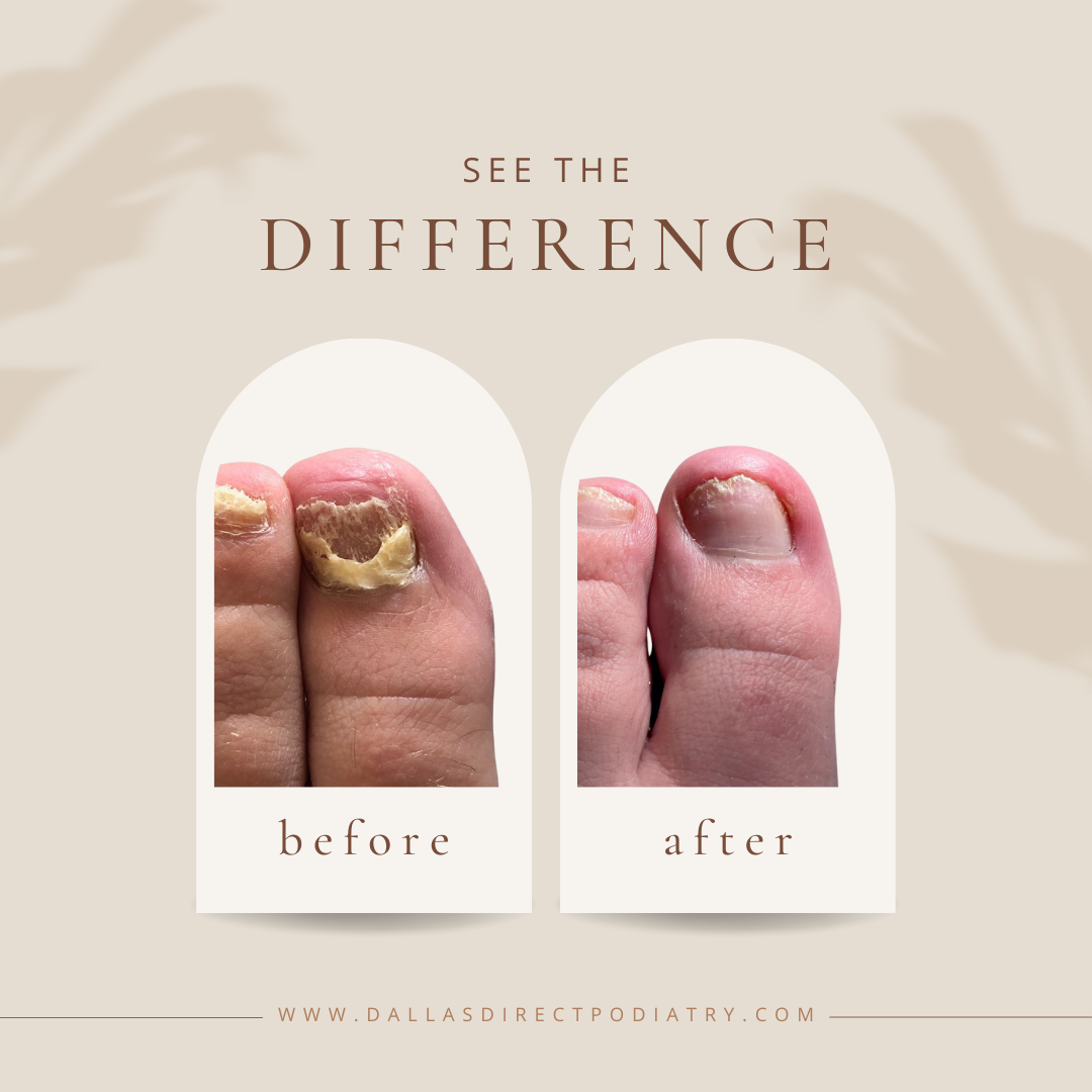Toenail Fungus Best Podiatrist In Dallas, TX